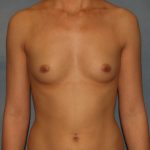 Breast Augmentation Before & After Patient #2794