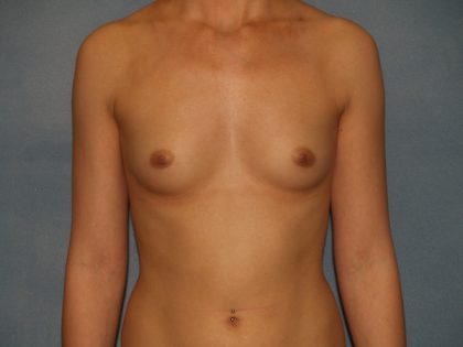 Breast Augmentation Before & After Patient #2794