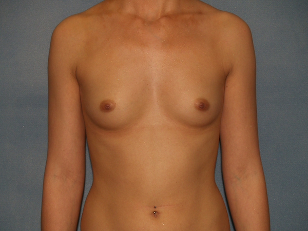 Breast Augmentation Before & After Patient #2794