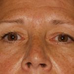 Eye Lid Lift Before & After Patient #709