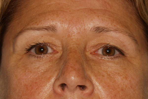 Eye Lid Lift Before & After Patient #709