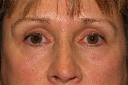 Eye Lid Lift Before & After Patient #709