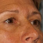 Eye Lid Lift Before & After Patient #709