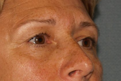 Eye Lid Lift Before & After Patient #709