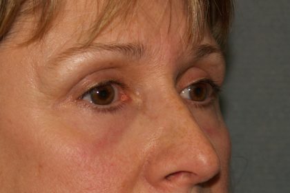 Eye Lid Lift Before & After Patient #709