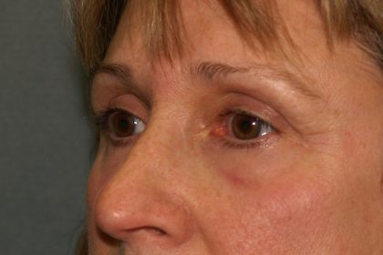 Eye Lid Lift Before & After Patient #709