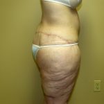 Circumferential Tummy Tuck Before & After Patient #905