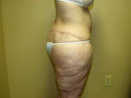 Circumferential Tummy Tuck Before & After Patient #905