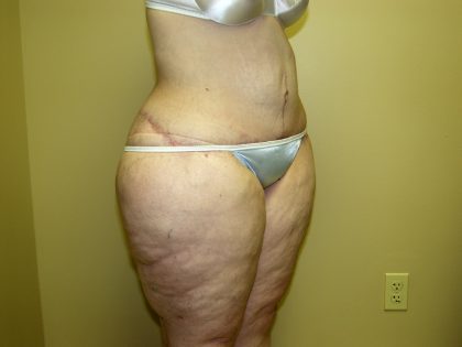 Circumferential Tummy Tuck Before & After Patient #905