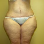 Circumferential Tummy Tuck Before & After Patient #905