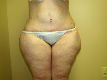 Circumferential Tummy Tuck Before & After Patient #905