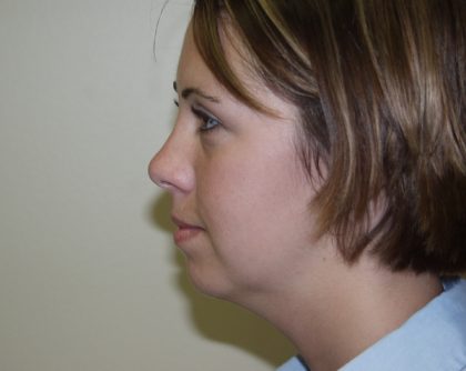 Chin Augmentation Before & After Patient #468