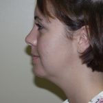Chin Augmentation Before & After Patient #468