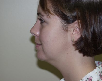 Chin Augmentation Before & After Patient #468