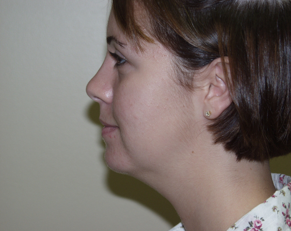 Chin Augmentation Before & After Patient #468
