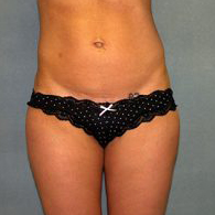 Liposuction Before & After Patient #3812