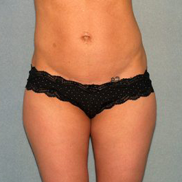 Liposuction Before & After Patient #3812