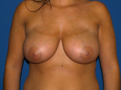Breast Reduction Before & After Patient #3082