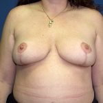 Breast Reduction Before & After Patient #3450