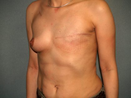 Breast Reconstruction Before & After Patient #2103