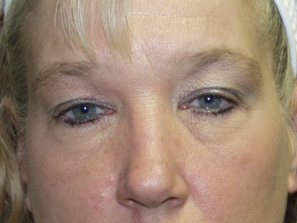 Eye Lid Lift Before & After Patient #691