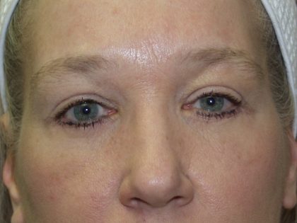 Eye Lid Lift Before & After Patient #691