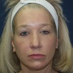 Facelift Before & After Patient #512