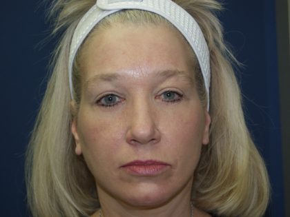 Facelift Before & After Patient #512