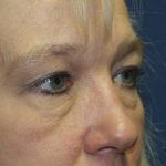 Eye Lid Lift Before & After Patient #691