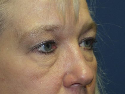 Eye Lid Lift Before & After Patient #691