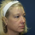 Facelift Before & After Patient #512