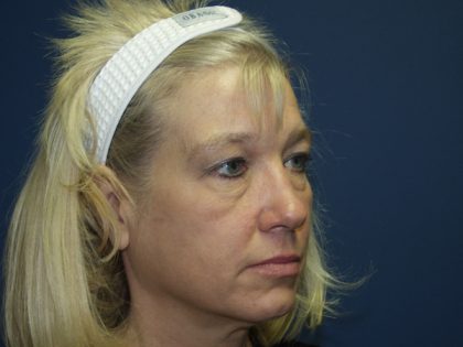 Facelift Before & After Patient #512