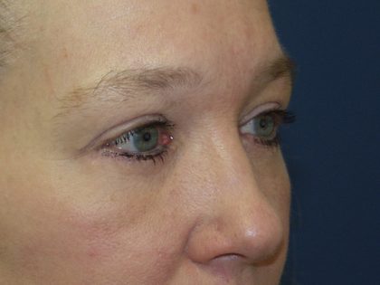 Eye Lid Lift Before & After Patient #691