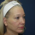 Facelift Before & After Patient #512