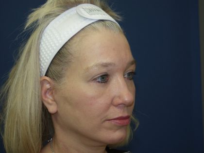 Facelift Before & After Patient #512