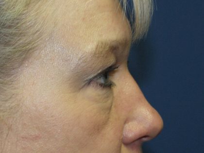 Eye Lid Lift Before & After Patient #691