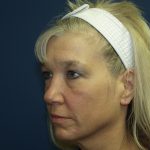 Facelift Before & After Patient #512