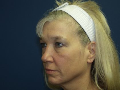 Facelift Before & After Patient #512