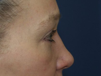 Eye Lid Lift Before & After Patient #691