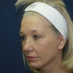 Facelift Before & After Patient #512