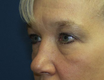 Eye Lid Lift Before & After Patient #691