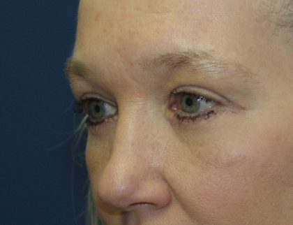 Eye Lid Lift Before & After Patient #691