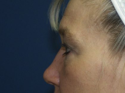 Eye Lid Lift Before & After Patient #691