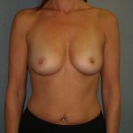 Breast Augmentation Before & After Patient #2766