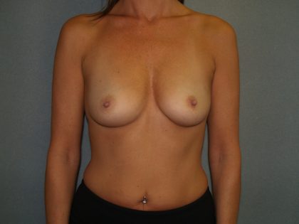 Breast Augmentation Before & After Patient #2766