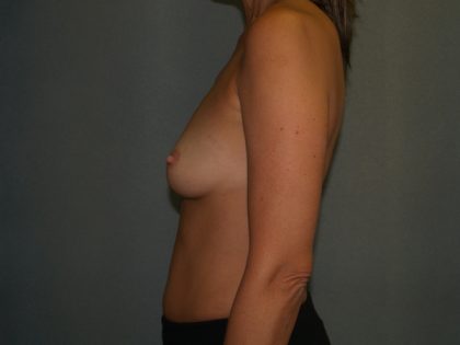 Breast Augmentation Before & After Patient #2766