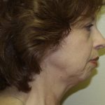 Facelift Before & After Patient #475