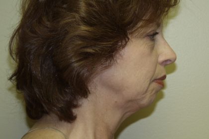 Facelift Before & After Patient #475