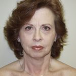 Facelift Before & After Patient #475