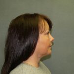 Chin Lipo Before & After Patient #482